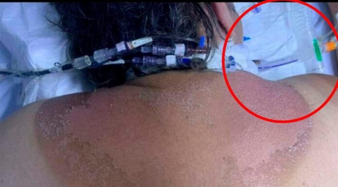 Así lucen los nuevos enfermos de Covid-19, “bronceados e intubados”